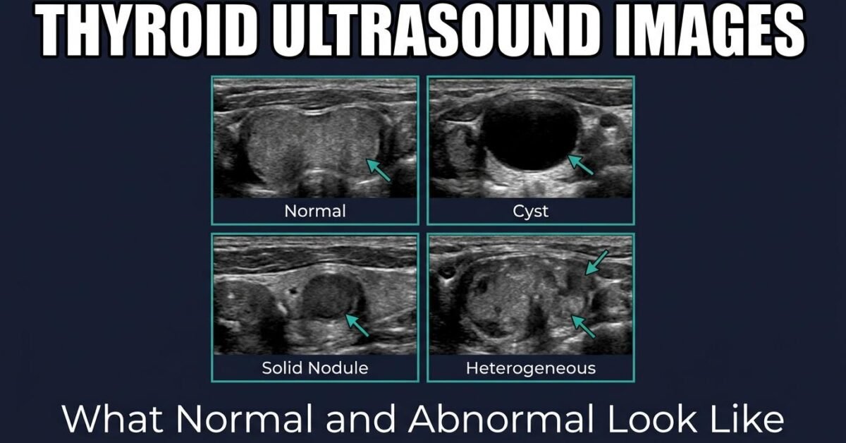 Thyroid ultrasound images comparing normal gland cyst solid nodule and heterogeneous appearances